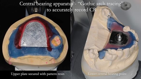 Finlay's Newsletter 58 Gasket upper partial denture for Zoe