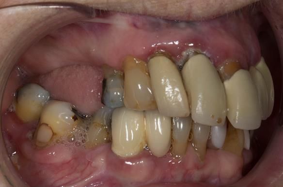 Figure 4 Pre - treatment. Failing upper teeth