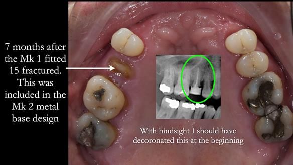 Finlay's Newsletter 63 Case study provision of metal based Scandinavian RPD - functional 10 years on
