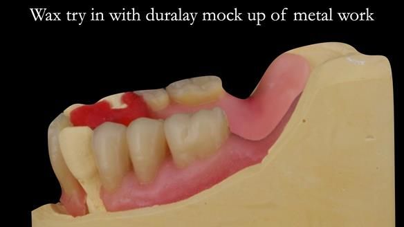 Finlay's Case Study Newsletter 40 - Immediate Mk 1 RPD to Definitive Mk 2 RPD - full protocol