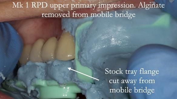 Newsletter 51 Managing Anne’s failing dentition with distal extension base RPD/Splint FULL PROTOCOL