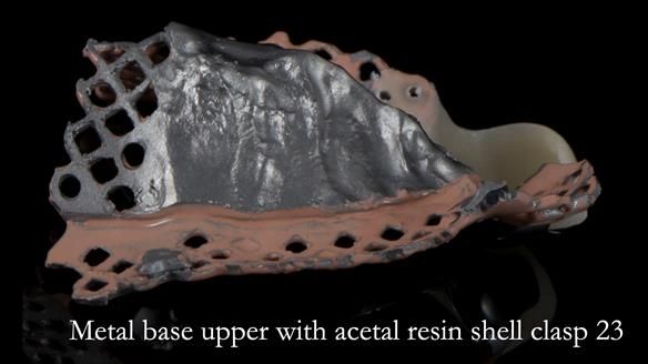 Newsletter 55 Provision of metal based partial dentures for Zephyrine with a repaired cleft lip and palate