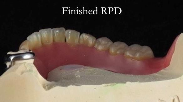 Finlay's Newsletter 59 Ultra hard partial dentures made for Gill