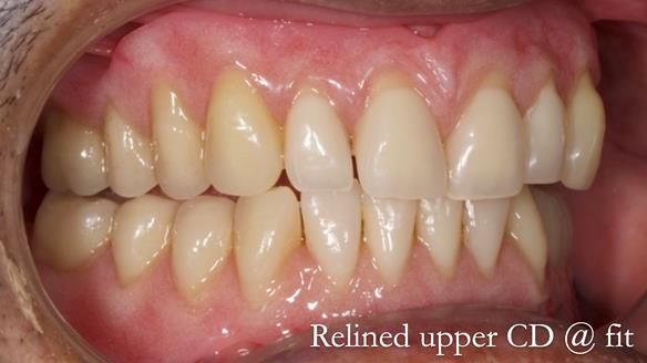 Finlay's Newsletter 62 provision of extractions and metal based complete dentures for Rafique