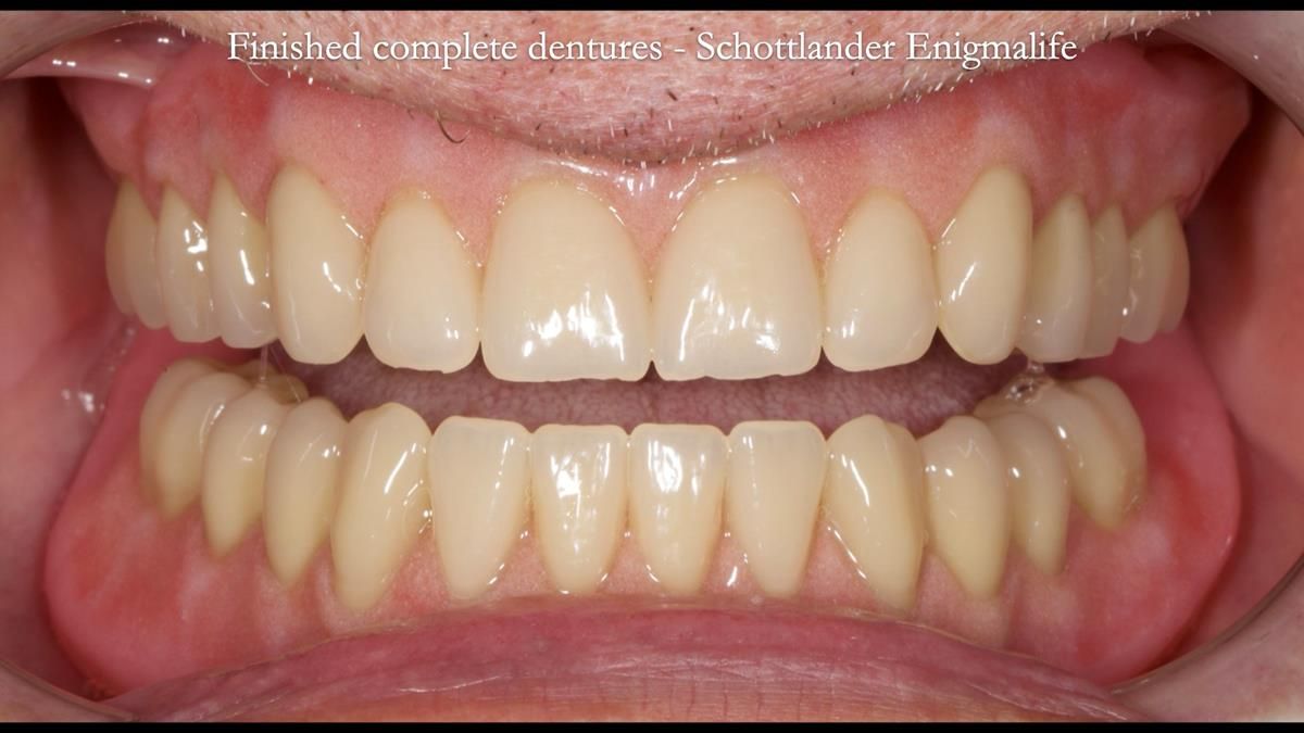 Fin’s Newsletter 88 — Complete dentures - full protocol… he rearranged his own teeth!