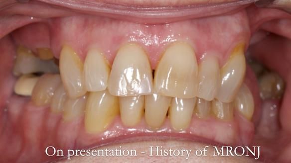 Finlay's Newsletter 60 Sylvia's upper Kennedy Class 2 Mod 1 metal based upper RPD