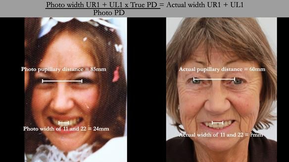 If a frontal dentate photograph of the patient is available then Dr John Besfords tooth size calculation formula can be used to calculate the size of the prosthetic teeth.