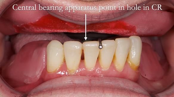 Newsletter 52 Managing Jo’s failing dentition with extractions and Mk 1/Mk 2 complete upper dentures and lower partial dentures FULL PROTOCOL