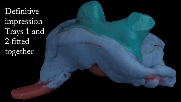 Upper metal base partial denture/occlusal stabilisation splint/obturator - full protocol