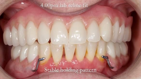 Newsletter 52 Managing Jo’s failing dentition with extractions and Mk 1/Mk 2 complete upper dentures and lower partial dentures FULL PROTOCOL