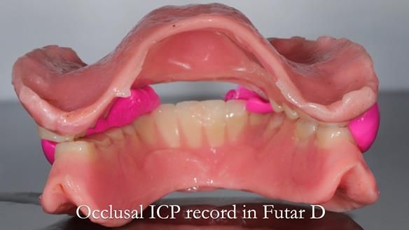 Finlay's Newsletter 62 provision of extractions and metal based complete dentures for Rafique