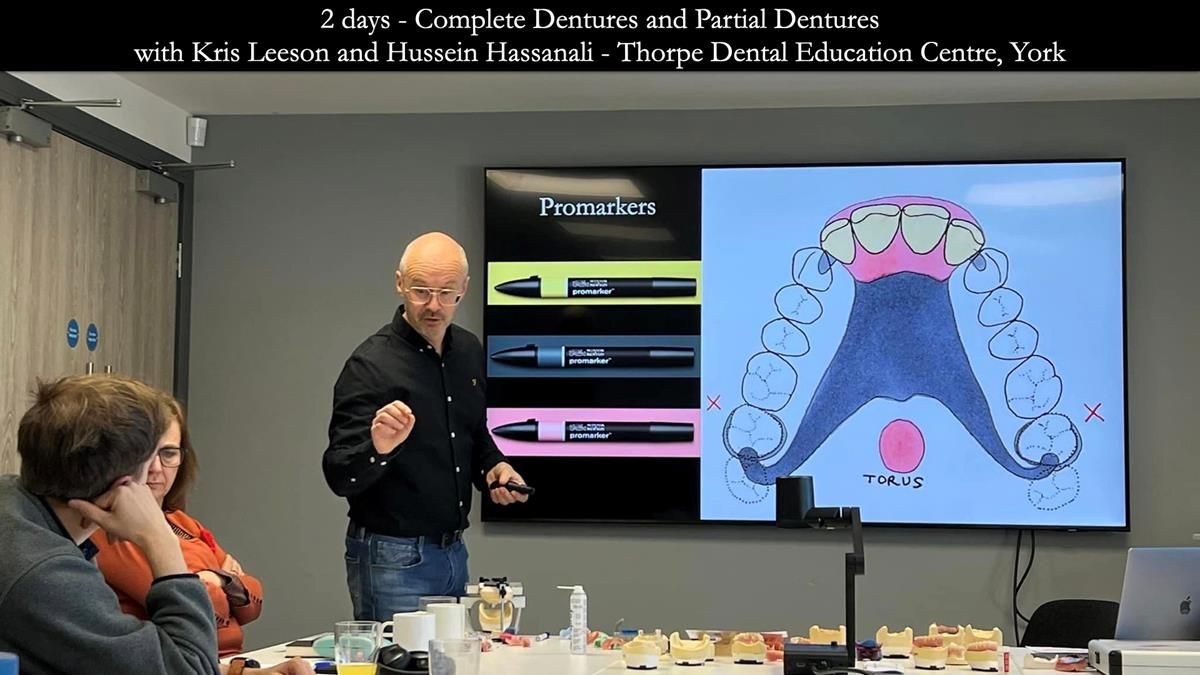 Finlay's Newsletter 59 Ultra hard partial dentures made for Gill