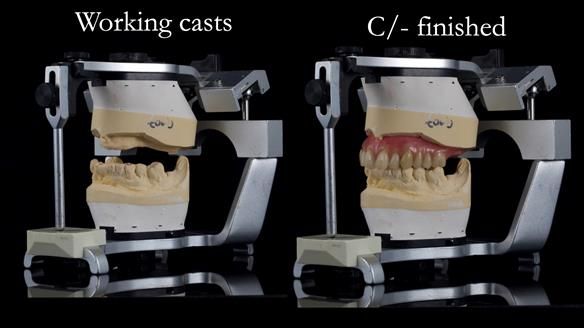 Newsletter 54 case presentation upper complete denture and lower Scandinavian designed hygienic partial denture for David