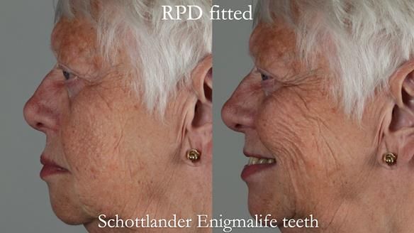 Finlay's Newsletter 59 Ultra hard partial dentures made for Gill