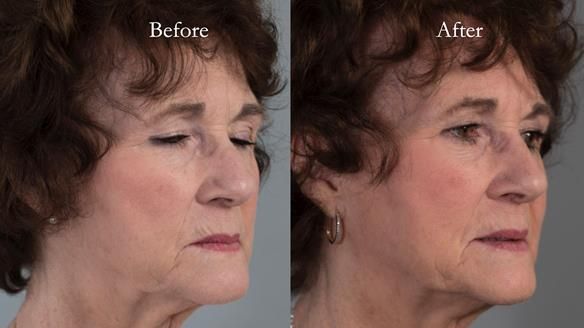 Newsletter 75: Marion’s case - Step-by-step complete denture workflow