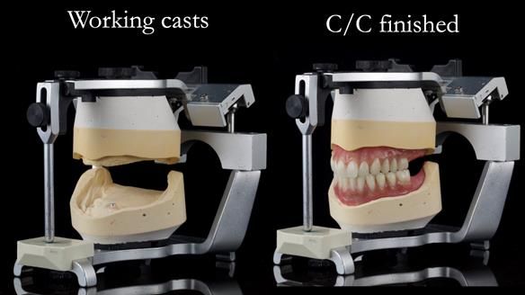 Managing poor implant positioning with complete dentures and Locator attachments - full protocol Newsletter 41