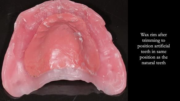Finlay's Newsletter 62 provision of extractions and metal based complete dentures for Rafique