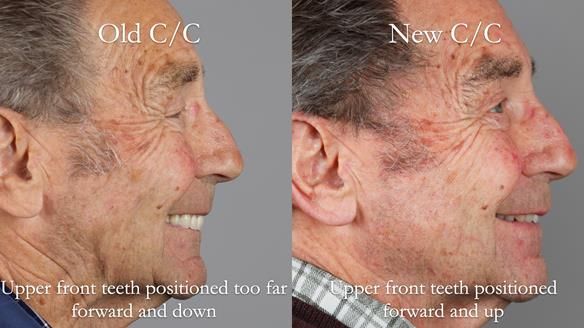 Newsletter 50 Special edition Complete Dentures FULL PROTOCOL