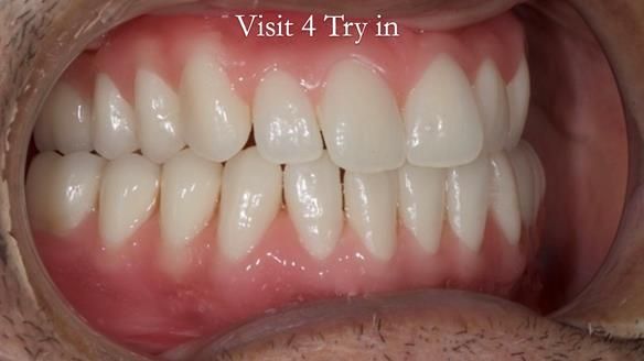 Managing poor implant positioning with complete dentures and Locator attachments - full protocol Newsletter 41