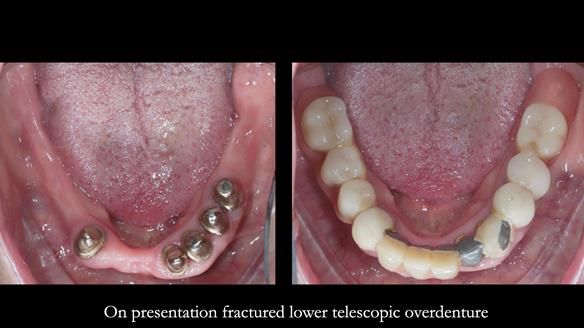 Newsletter 76: Jackie’s case – Telescopic overdenture & precision RPD (the tricky truth!)