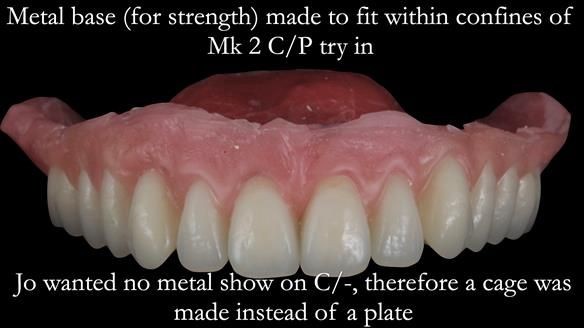 Newsletter 52 Managing Jo’s failing dentition with extractions and Mk 1/Mk 2 complete upper dentures and lower partial dentures FULL PROTOCOL