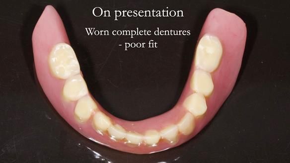 Newsletter 57 showcases the making and fitting process of implant-supported complete dentures for Alisdair