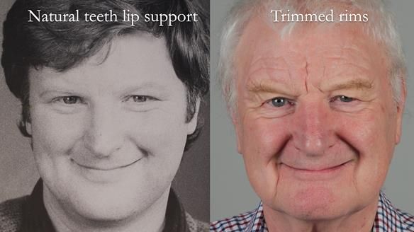 Newsletter 57 showcases the making and fitting process of implant-supported complete dentures for Alisdair