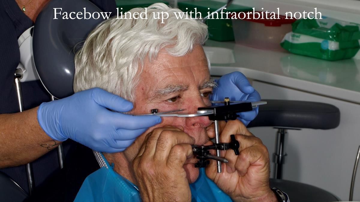 Fin’s Newsletter 88 — Complete dentures - full protocol… he rearranged his own teeth!