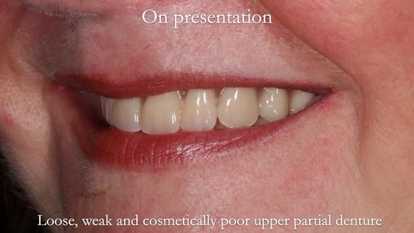 Finlay's Newsletter 58 Gasket upper partial denture for Zoe