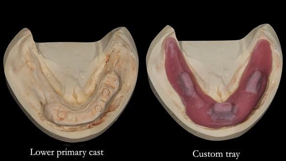 Newsletter 44 - extreme removable prosthodontics – engineering a super-strong and ultra-thin over denture