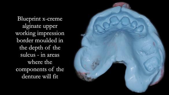 Finlay's Newsletter 60 Sylvia's upper Kennedy Class 2 Mod 1 metal based upper RPD