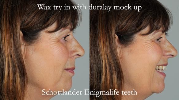 Newsletter 56 showing the making and fitting of a bilateral free end saddle upper removable partial denture (RPD) for patient with pemphigus
