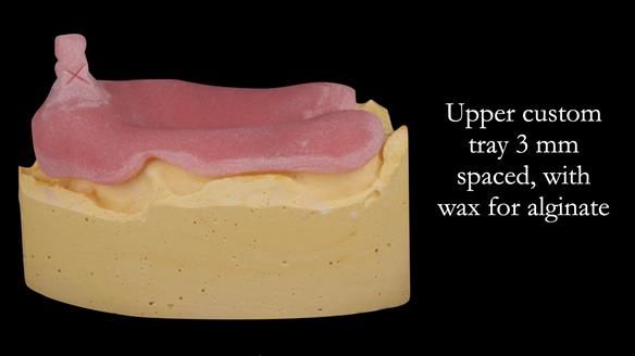 Complete denture Class II div 2 deep overbite Newsletter 39