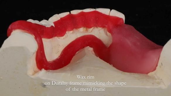 Finlay's Newsletter 61 provision of a lower unilateral free end saddle metal based partial denture for Joyce