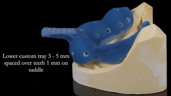 Newsletter 55 Provision of metal based partial dentures for Zephyrine with a repaired cleft lip and palate