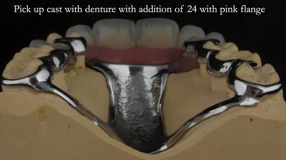 Finlay's Newsletter 63 Case study provision of metal based Scandinavian RPD - functional 10 years on