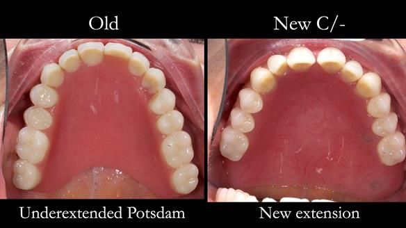 Solving Linda’s Failed “All on 4” implant bridges - full protocol Newsletter 42