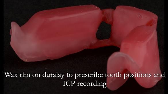 Finlay's Case Study Newsletter 40 - Immediate Mk 1 RPD to Definitive Mk 2 RPD - full protocol