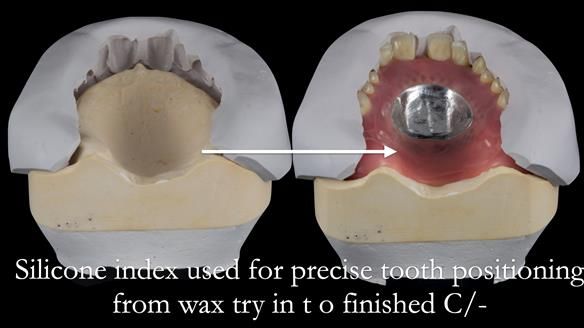 Newsletter 53 showing the making and fitting of ultra life-like dentures for Valena