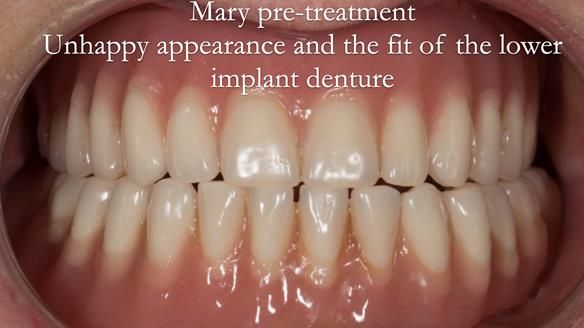Pre-treatment - upper complete denture lower - implant supported complete denture. Locator attachments not engaging the housings in the lower denture. Sub-optimally shaped dentures with poor tissue fit resulting in rocking of the dentures. Bland aesthetic