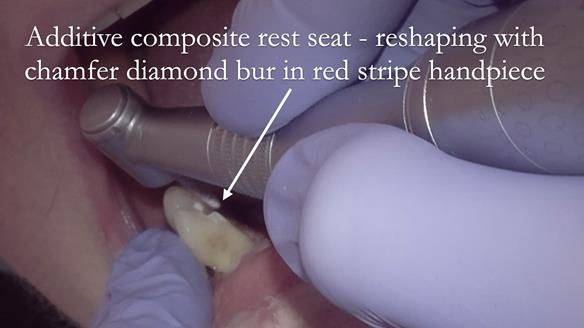 Finlay's Case Study Newsletter 40 - Immediate Mk 1 RPD to Definitive Mk 2 RPD - full protocol