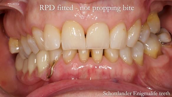 Finlay's Newsletter 61 provision of a lower unilateral free end saddle metal based partial denture for Joyce