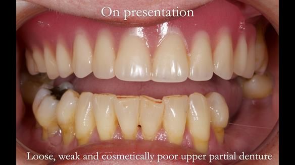 Finlay's Newsletter 58 Gasket upper partial denture for Zoe