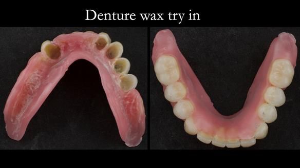 Newsletter 76: Jackie’s case – Telescopic overdenture & precision RPD (the tricky truth!)