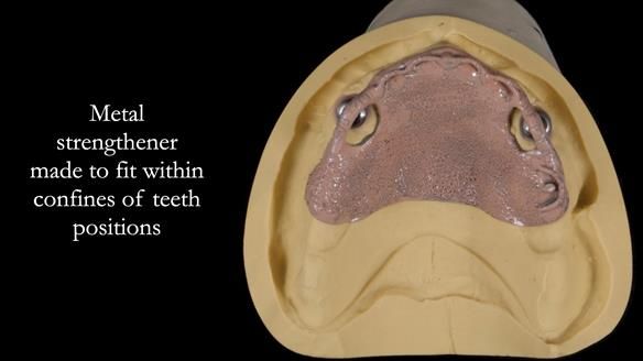 Newsletter 57 showcases the making and fitting process of implant-supported complete dentures for Alisdair