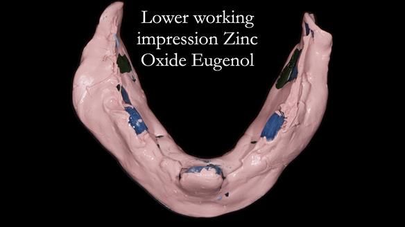 Newsletter 80 - Gordon’s dentures: the one case in 1,000 where my technique failed