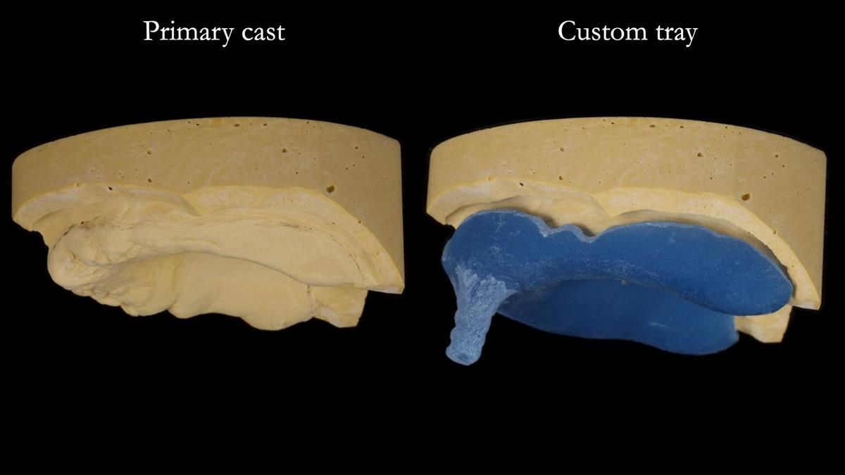 Fin’s Newsletter 88 — Complete dentures - full protocol… he rearranged his own teeth!