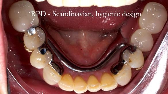 Solving Linda’s Failed “All on 4” implant bridges - full protocol Newsletter 42
