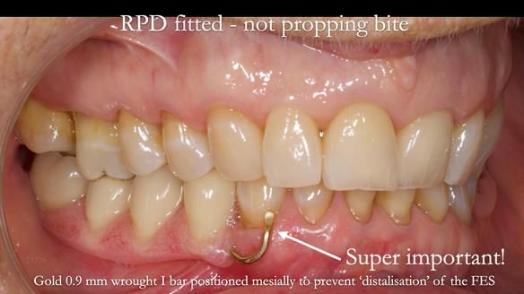 Finlay's Newsletter 61 provision of a lower unilateral free end saddle metal based partial denture for Joyce