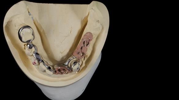 Newsletter 86 Peter the Architect — precision removable partial dentures case study